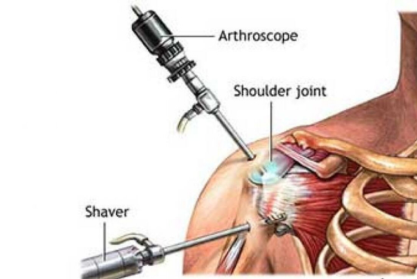 باحثون إيرانيون ينجحون في تصنيع خيوط لاستخدامها في جراحة العظام