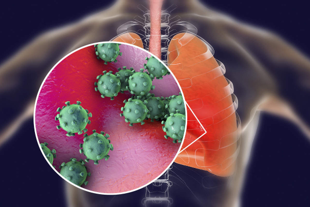 دراسة مثيرة للقلق حول تداعيات كورونا على الرئة (صورة)