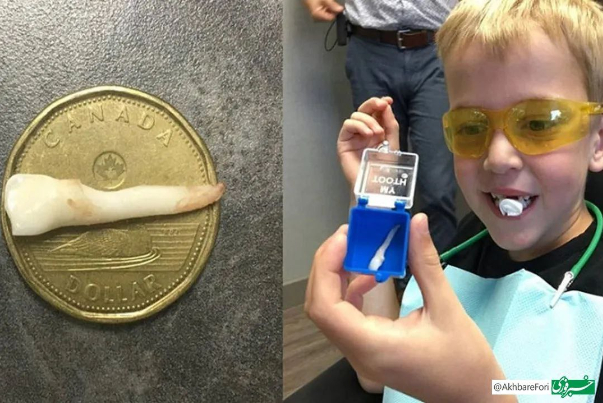 Largest baby tooth recorded in Guinness