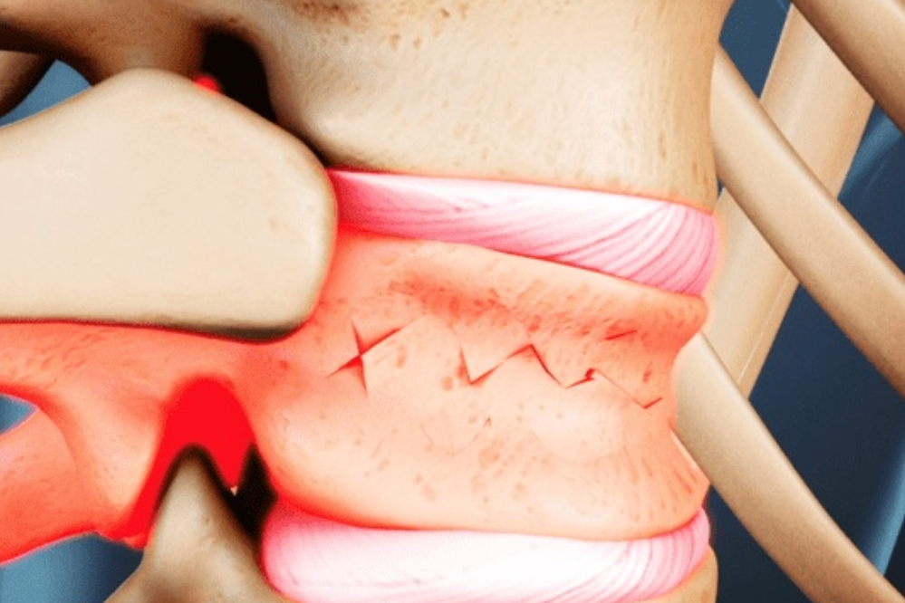 ترمیم شکستگی‌های ستون فقرات با سلول‌های بنیادی چربی