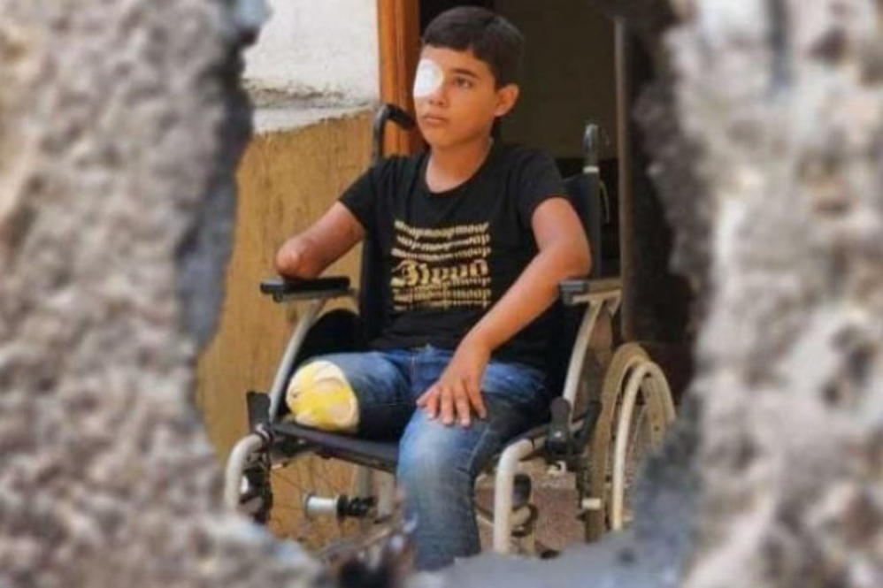 6,000 קטועי גפיים בעזה זקוקים בדחיפות לתוכניות שיקום