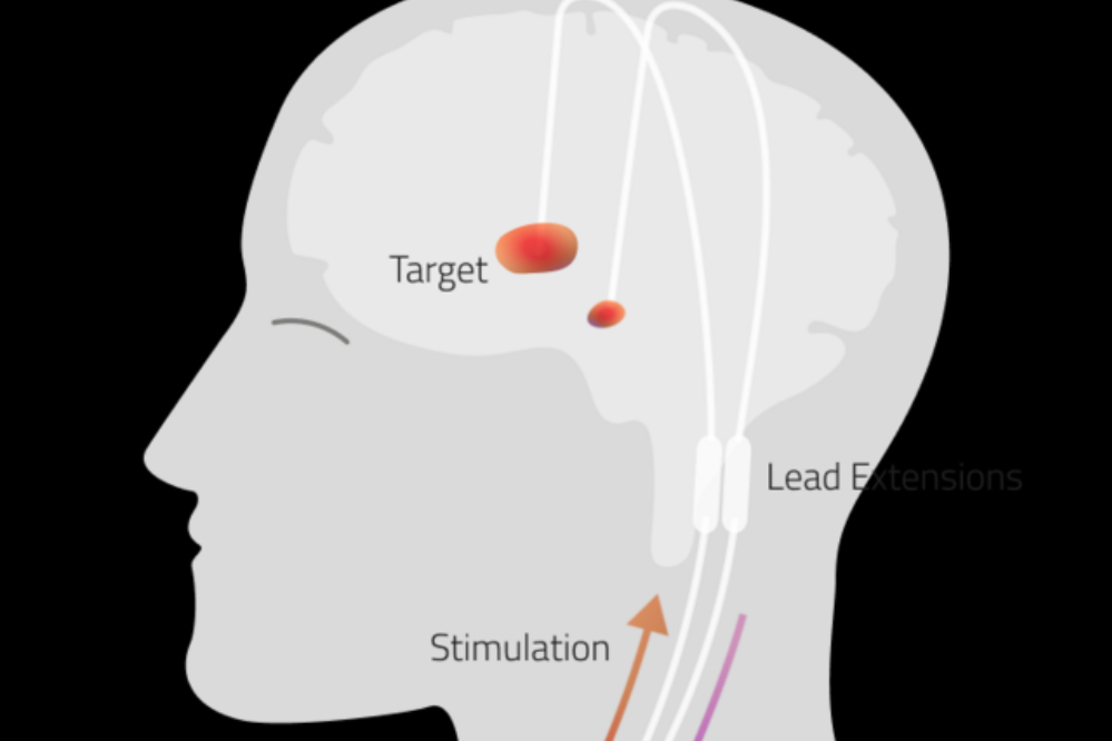 بومی‌سازی چرخه فناوری تحریک عمقی مغز