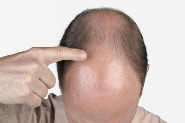 هیچ دارویی موجب رویش مجدد مو نمی شود/تبلیغات فعلی تقلید از ماهواره