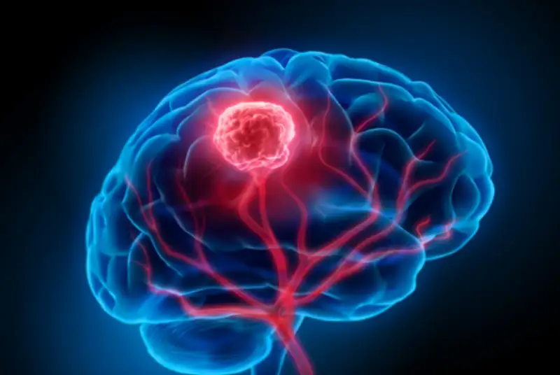 هوش مصنوعی تومور مغزی را ردیابی می کند