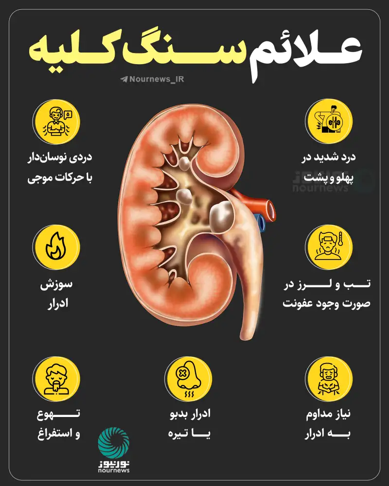 علائم سنگ کلیه
