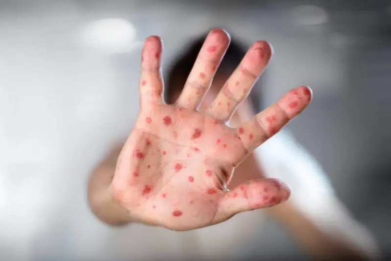 افزایش مبتلایان به آبله میمونی در پرو