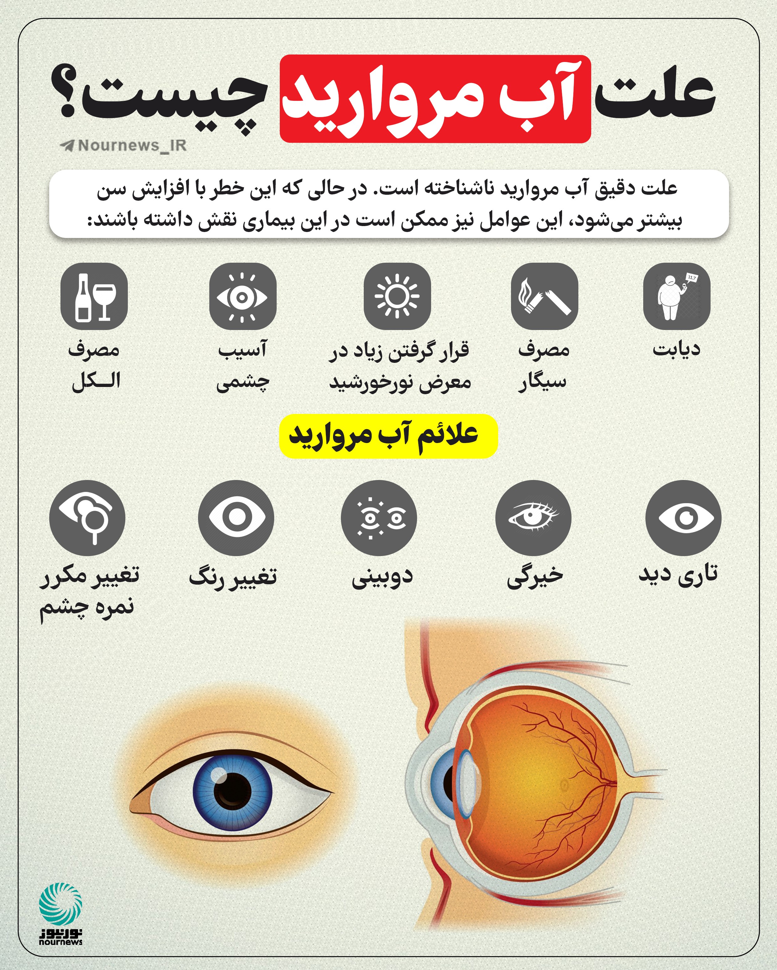 علت آب مروارید چیست؟