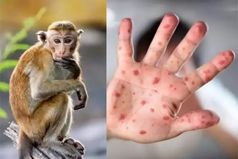 آبله میمونی در آستانه نابودی