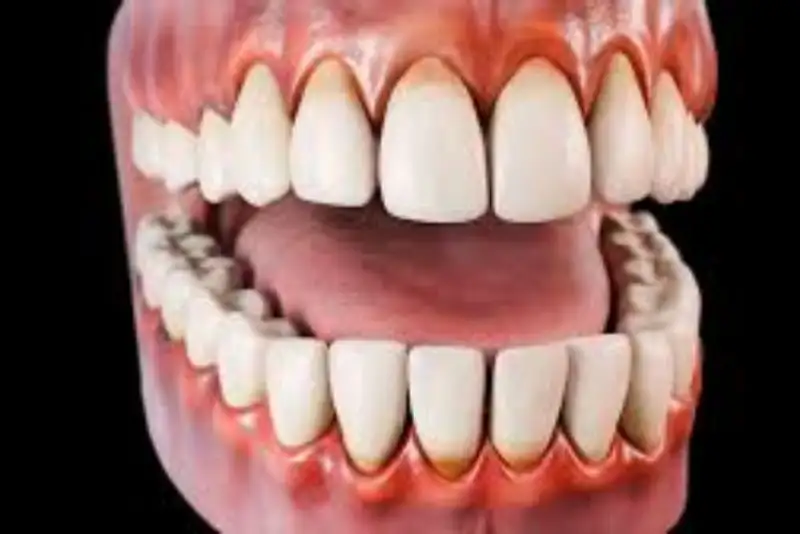 افزایش آسیب پذیری مغز با بیماری لثه