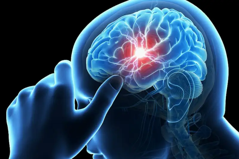 سکته مغزی دومین عامل مرگ در کشور