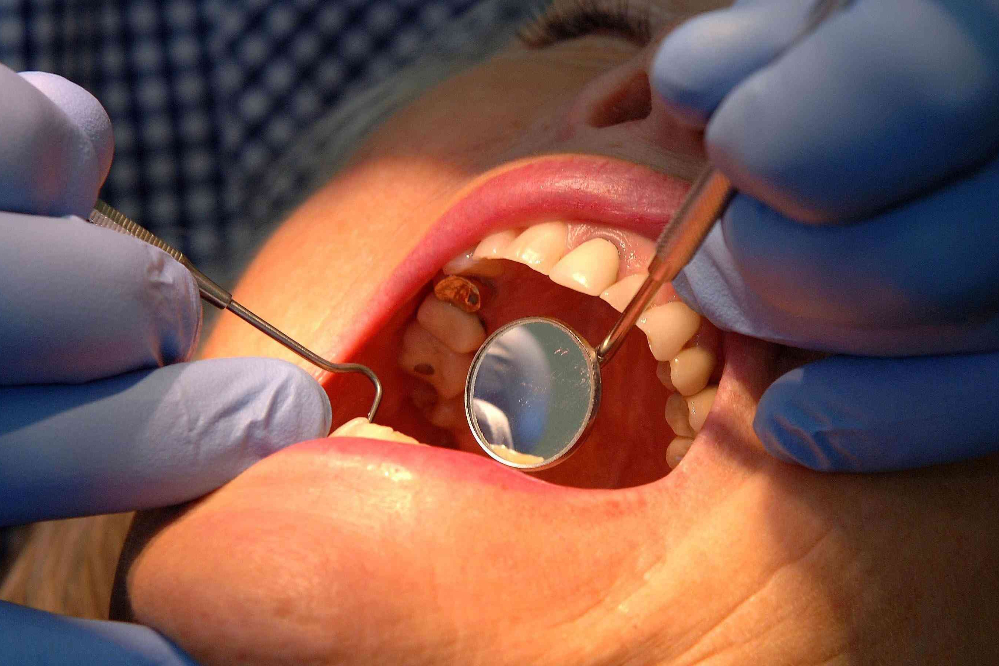 ساخت ژلی که  پوسیدگی دندان را بهتر درمان می کند