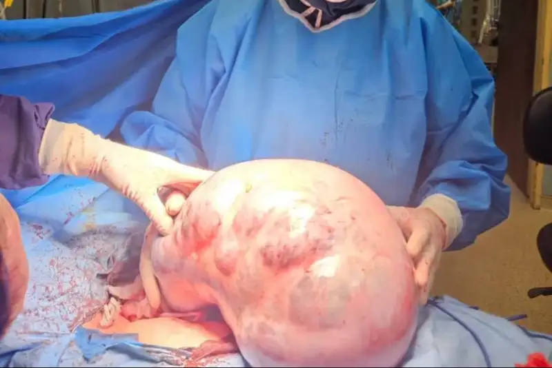 خارج‌ کردن توده 10 کیلویی از شکم یک بیمار