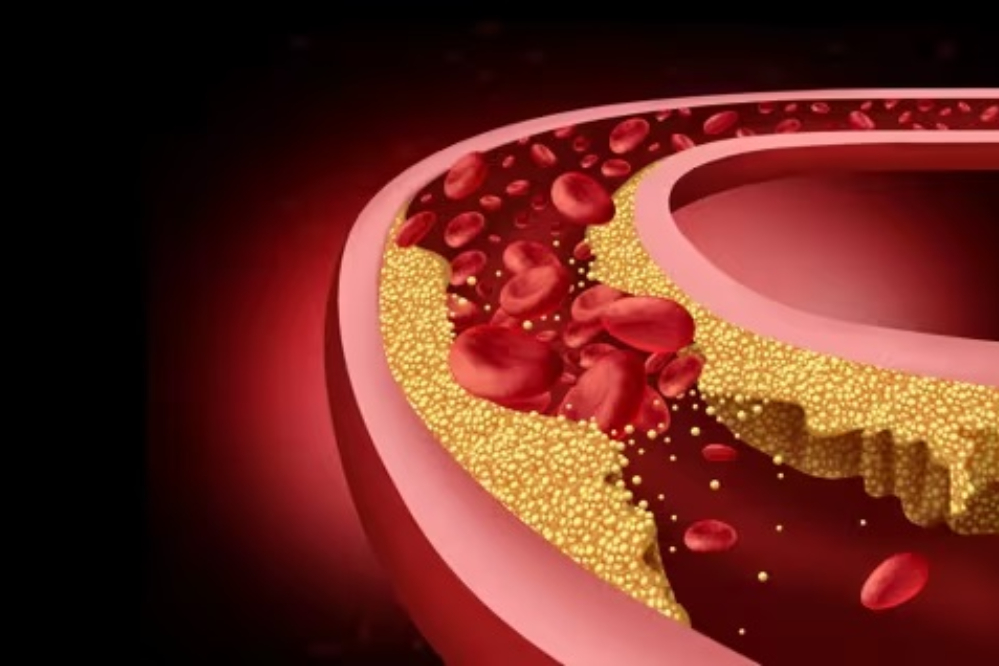 کاهش  کلسترول بد با ژن درمانی