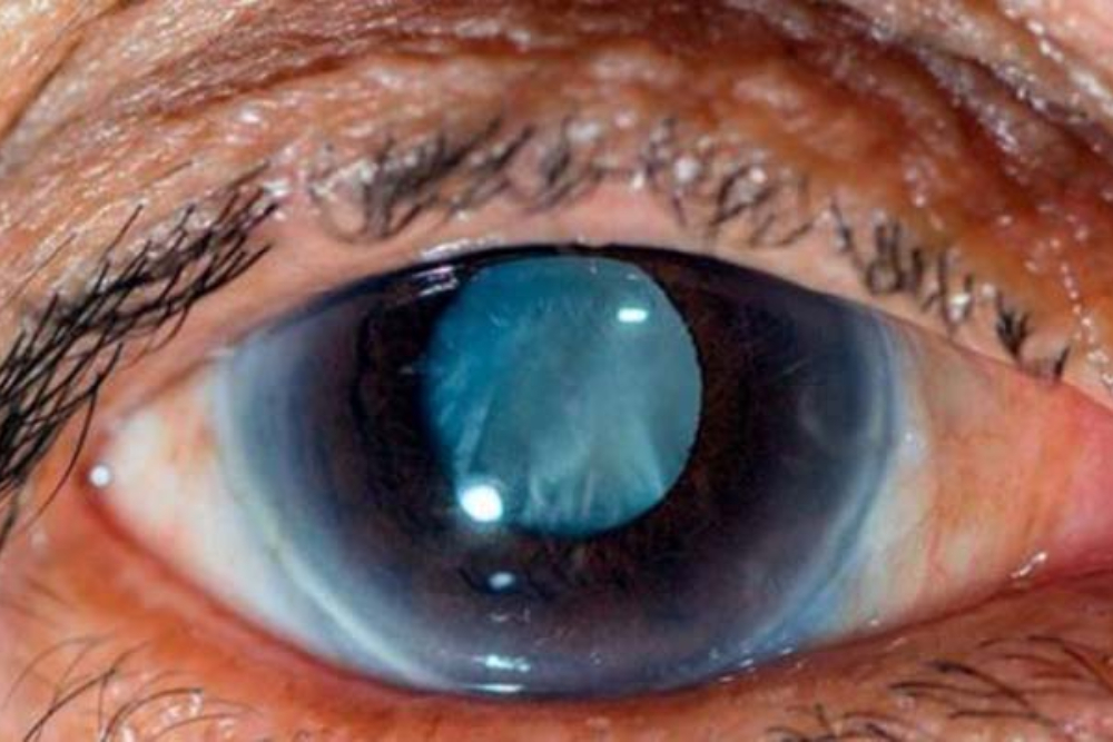 تشخیص زودهنگام «آب‌سیاه» ممکن شد