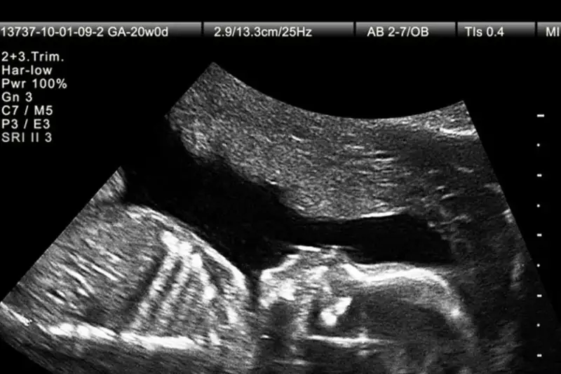 پیشرفت‌های تصویربرداری در بارداری؛ تشخیص زودهنگام سندرم داون