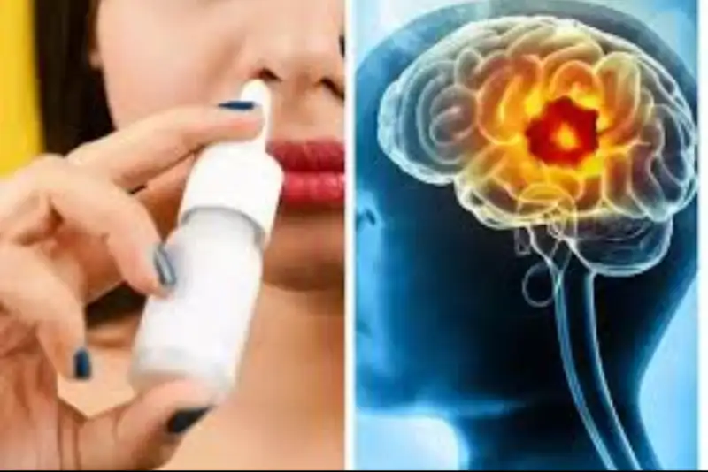 پیشرفت شگفت‌انگیز پزشکی/حذف تومور مغزی با قطره بینی