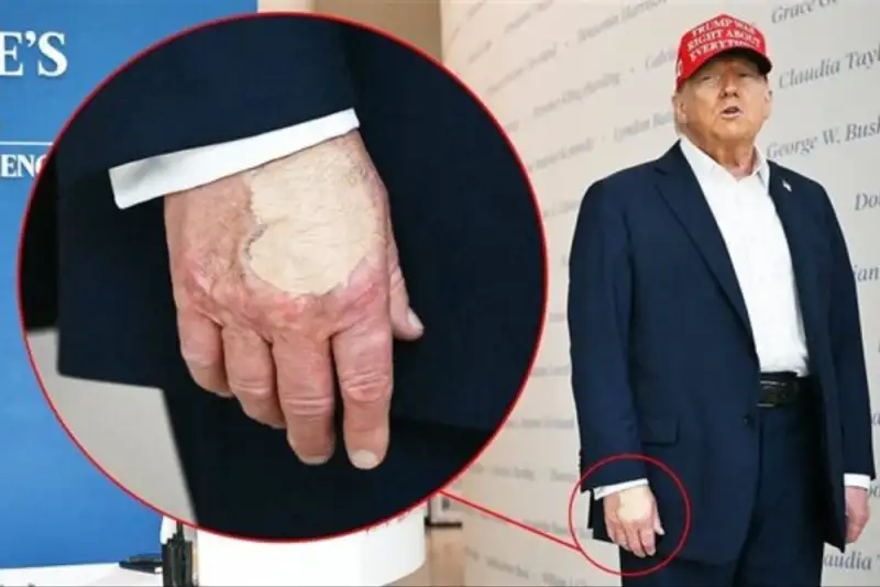 واکنش عجیب کاخ سفید به تصاویر بانداژ روی دست ترامپ