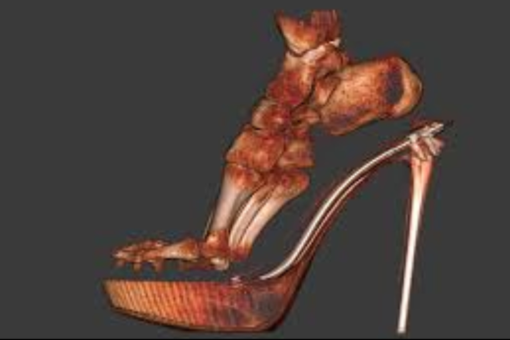 پاشنه‌بلند؛ زیبایی پرهزینه‌ای که شکل پا را تغییر می‌دهد