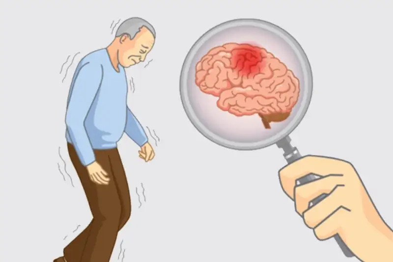 رابطه چاقی و شتاب پیشرفت آلزایمر