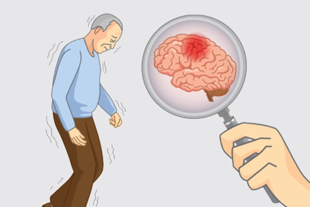 رابطه چاقی و شتاب پیشرفت آلزایمر