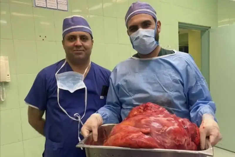 خارج کردن توده 23 کیلویی از شکم خانم تبریزی