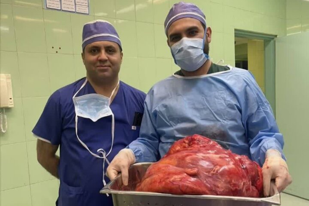 خارج کردن توده 23 کیلویی از شکم خانم تبریزی