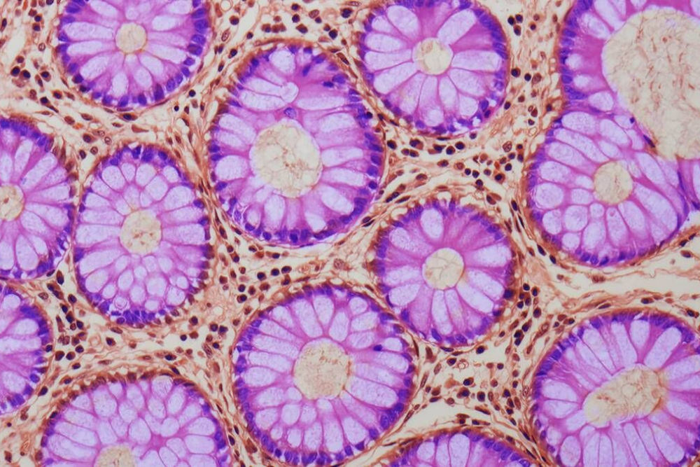 عواملی که زمینه‌ساز سرطان روده بزرگ هستند را بشناسید