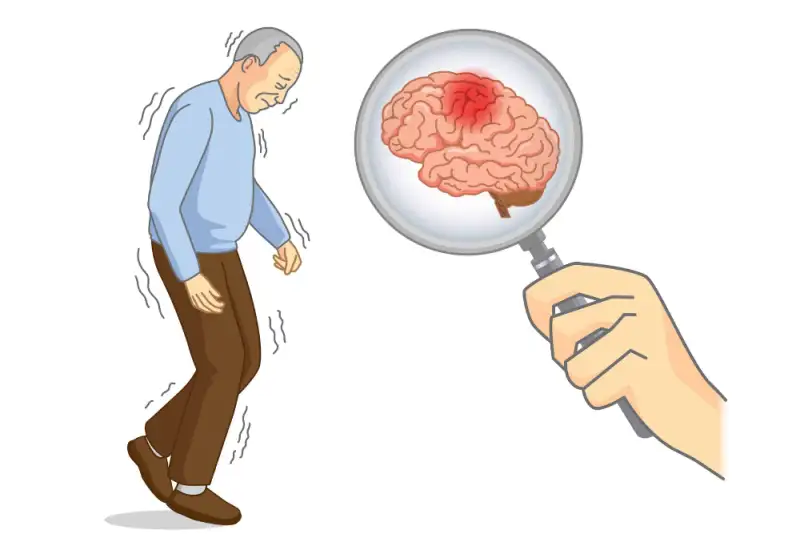 درمان پارکینسون در رویان