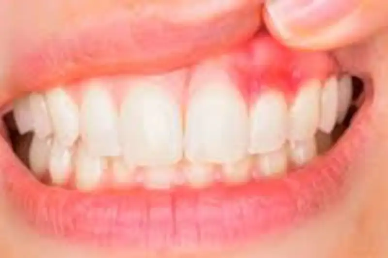 برچسبی که التهاب لثه را تشخیص می‌دهد!