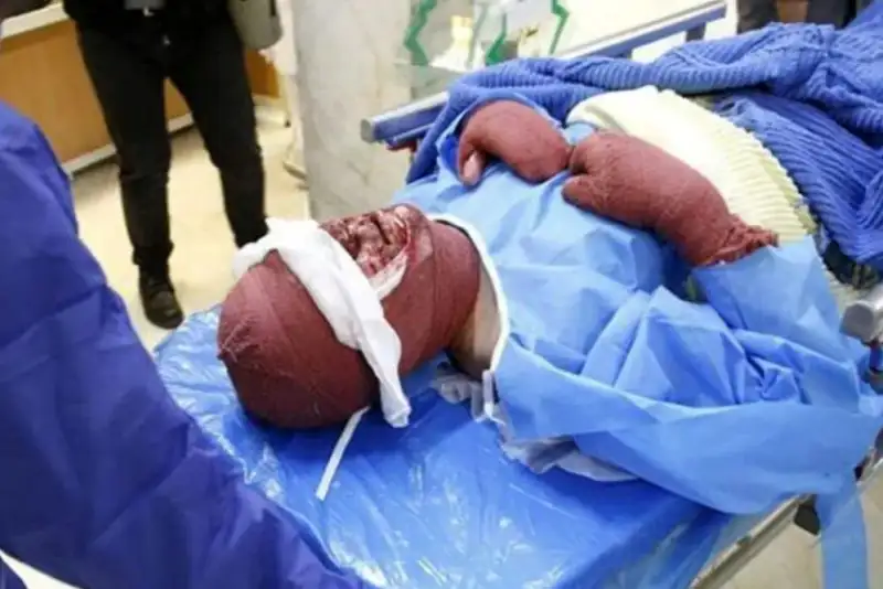 31 نفر بر اثر سوختگی در کردستان جان باختند