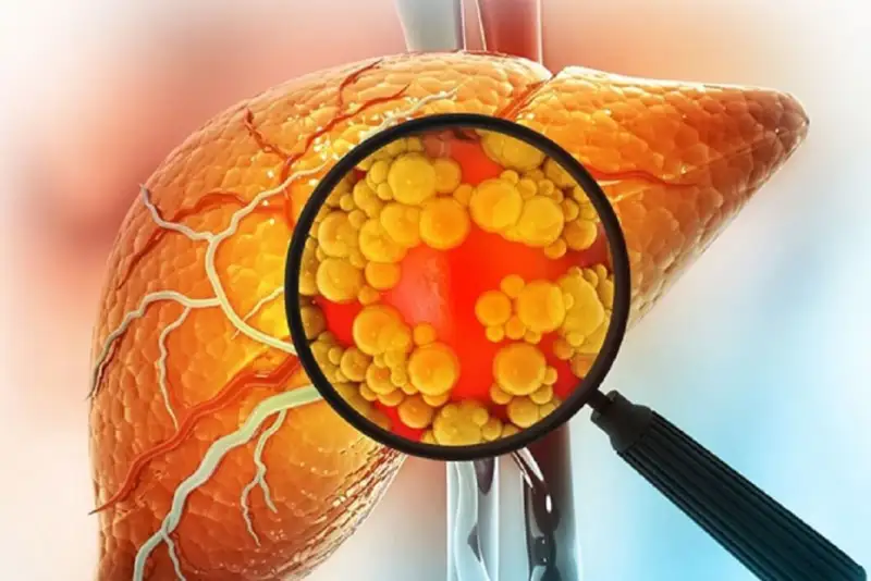 مهمترین علت چرب شدن کبد چیست؟