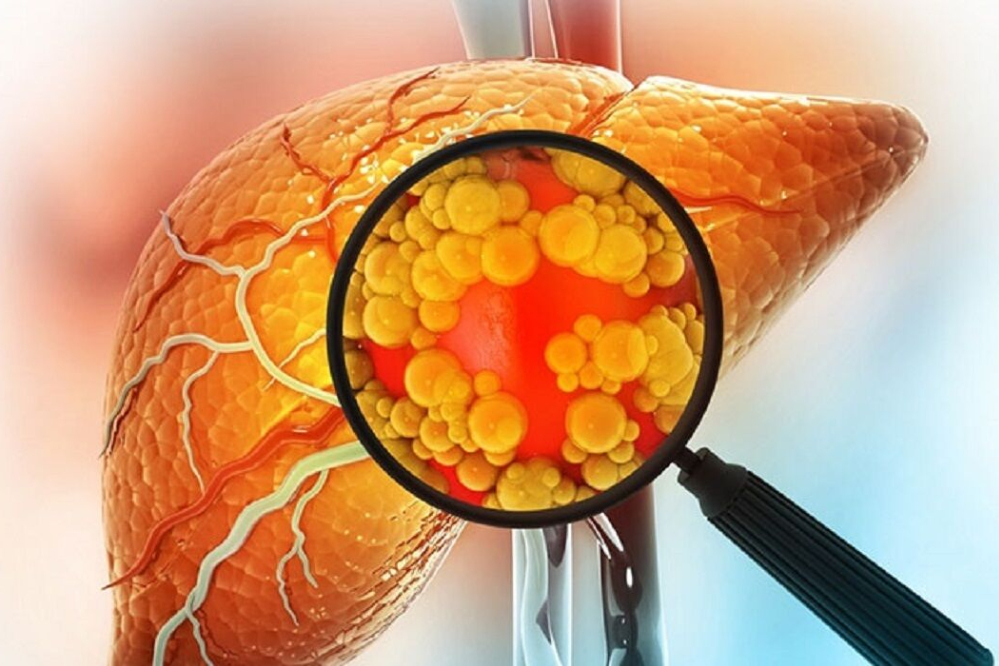 مهمترین علل چرب شدن کبد چیست؟