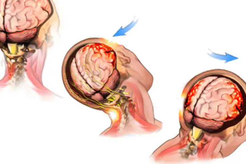 ضربه‌های تکراری به سر چه بلایی بر مغز می‌آورد؟